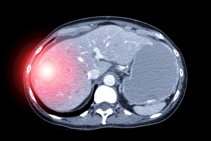 phân mức độ nguy hiểm khi vỡ gan