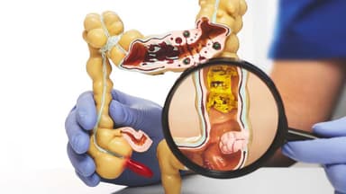 Đừng chủ quan với 8 dấu hiệu ung thư đại tràng