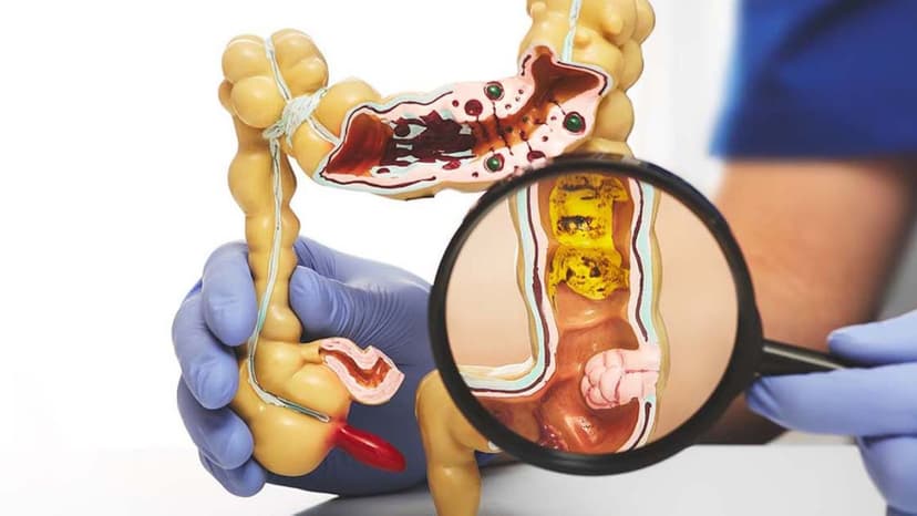 Phát hiện sớm 5 biểu hiện ung thư đại tràng