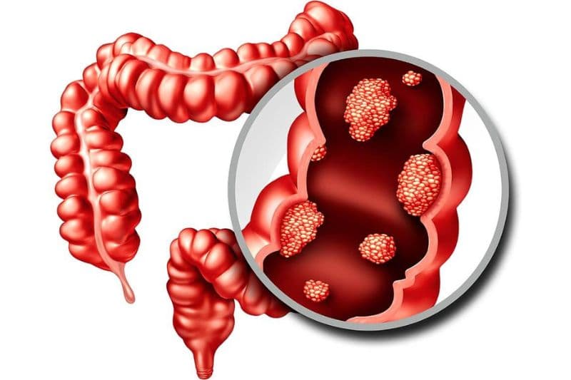 biểu hiện ung thư đại tràng có nguy hiểm không