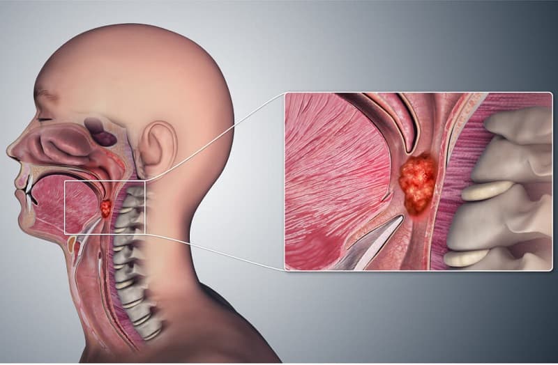 Giai đoạn IVB là giai đoạn bệnh đã lây lan ra ngoài khu vực đầu - cổ, di căn đến các cơ quan xa như xương, phổi, gan hoặc não