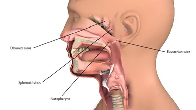 Phương hướng điều trị ung thư vòm họng giai đoạn IV