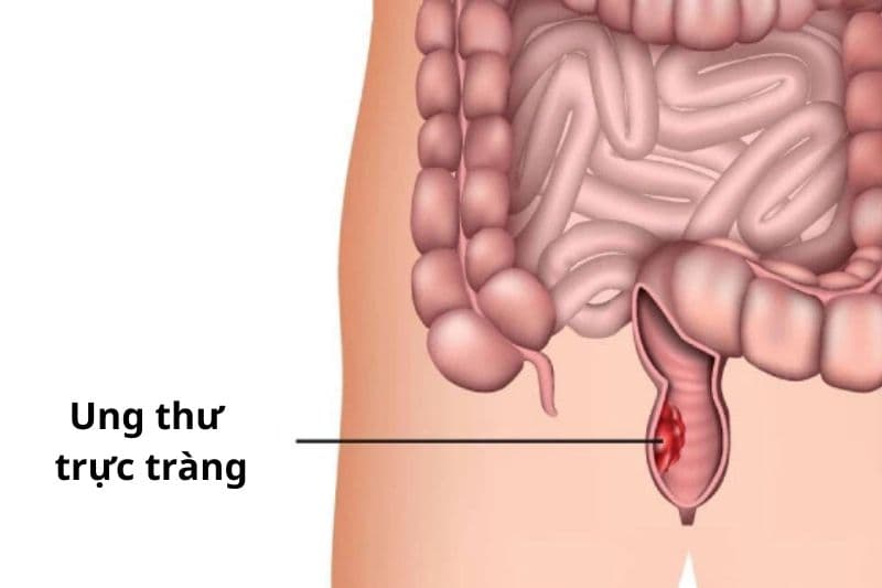 điều trị ung thư trực tràng và tính nguy hiểm