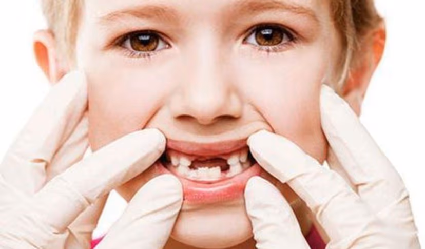 Nguyên nhân và cách phòng tránh sâu răng em bé hiệu quả