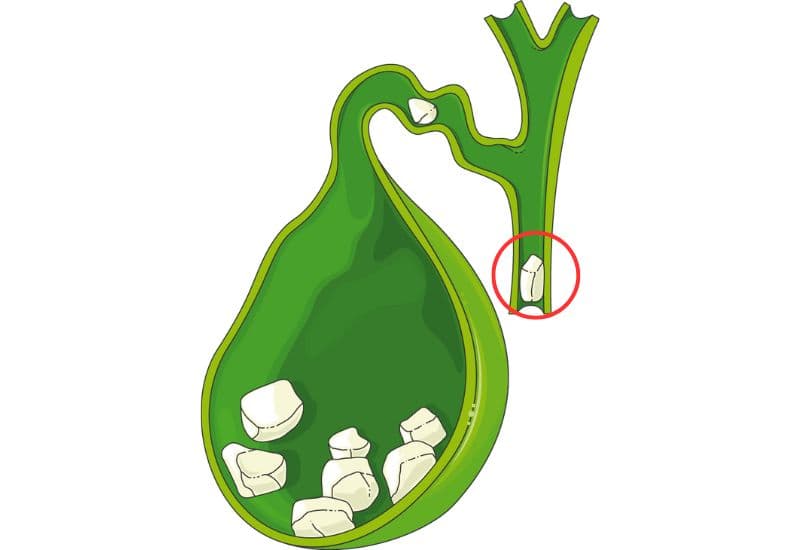 Sỏi ống mật chủ là gì và vì sao lại hình thành?