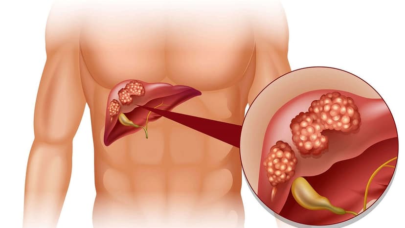 Tất tần tật thông tin về ung thư máu gan mà bạn cần biết