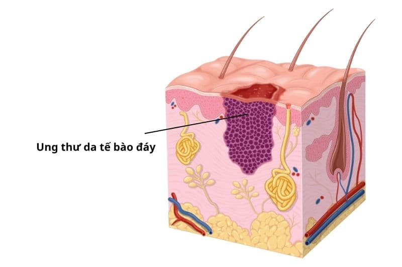 nhận biết ung thư da tế bào đáy