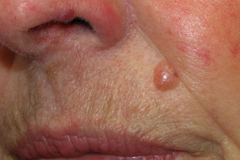 biểu hiện nốt sần ung thư da