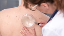 Tất tần tật về dấu hiệu ung thư da tế bào đáy