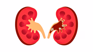 Phát hiện sớm thận ứ nước độ 1 có sỏi nhờ dấu hiệu ít ngờ tới