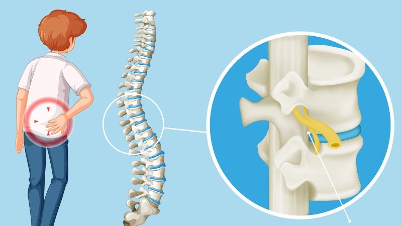 Thoát vị đĩa đệm là bệnh gì?