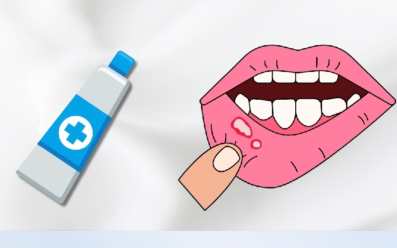 Thuốc bôi nhiệt miệng hiện nay