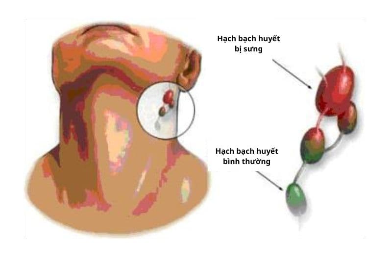 ung thư vòng họng và các dấu hiệu