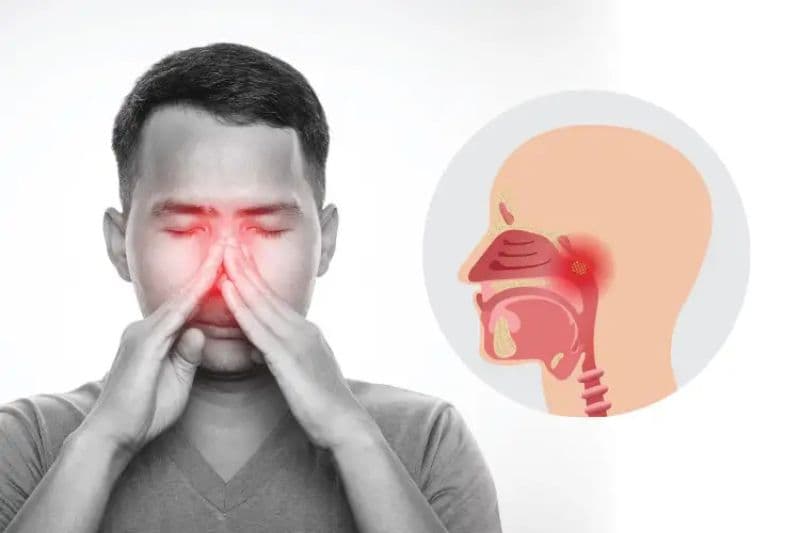 nghẹt mũi là triệu chứng ung thư vòm họng