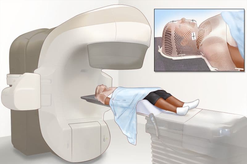 xạ trị là phương pháp điều trị ung thư vòm họng