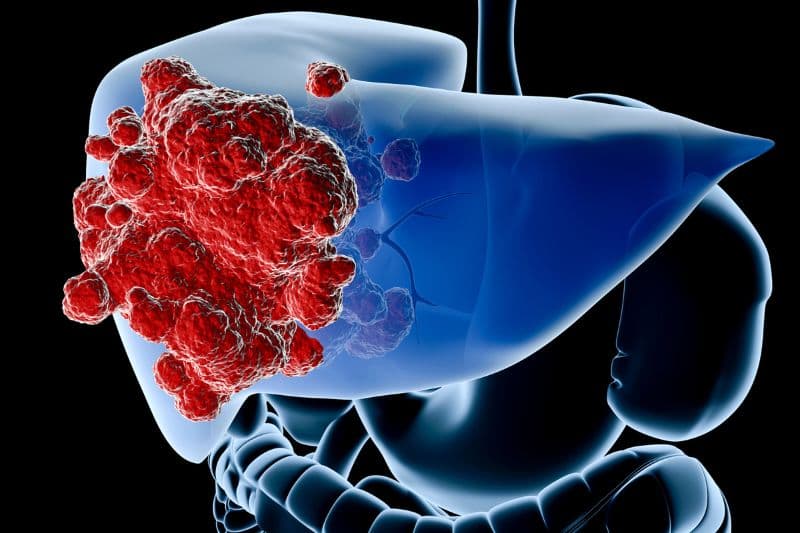 ung thư đại tràng đa số di căn sang gan