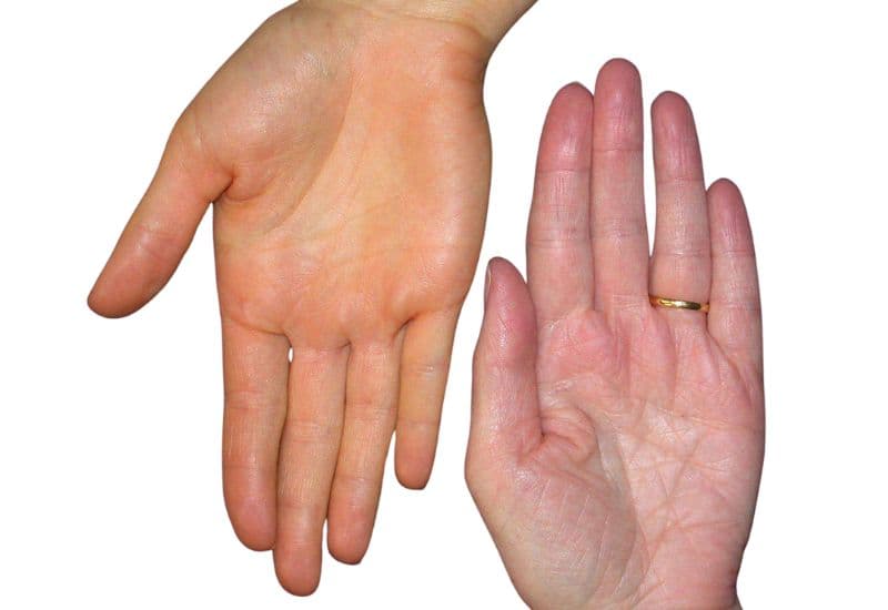 Sỏi ống mật chủ gây ra những triệu chứng gì?