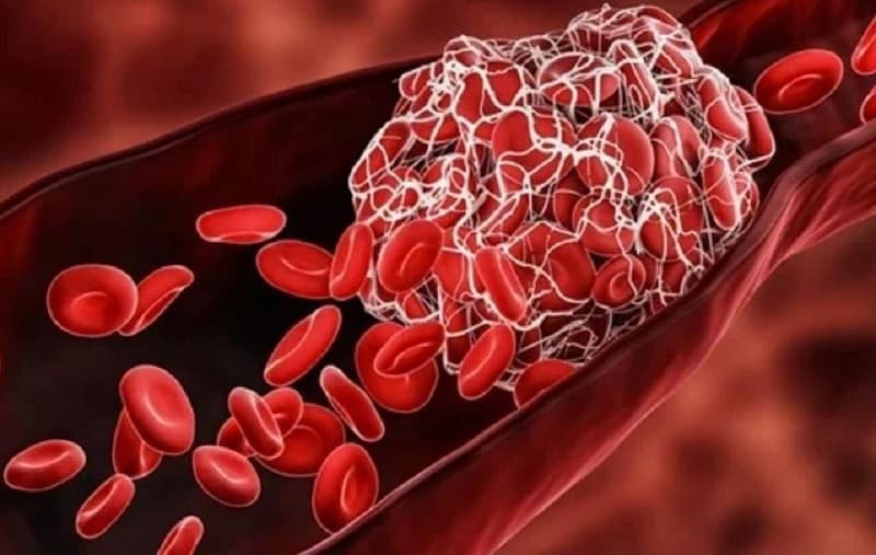Xuất hiện cục máu đông là một trong những triệu chứng của ung thư tuyến tụy