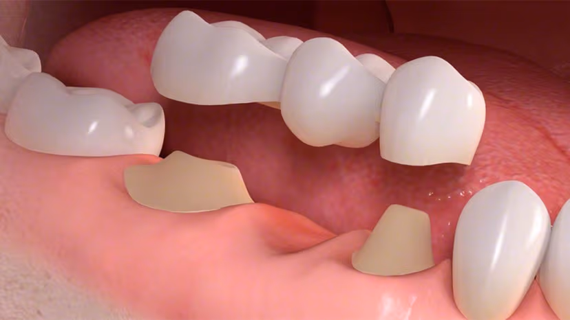 Trồng răng sứ là gì? Lợi ích và quy trình chuẩn y khoa bạn cần biết