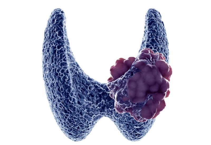 Vì sao cần phát hiện sớm khối u tuyến giáp ác tính?