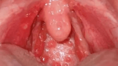 Viêm họng hạt – Thông tin và cách điều trị