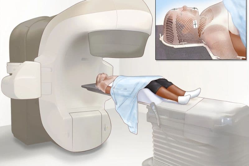 xạ trị ung thư não