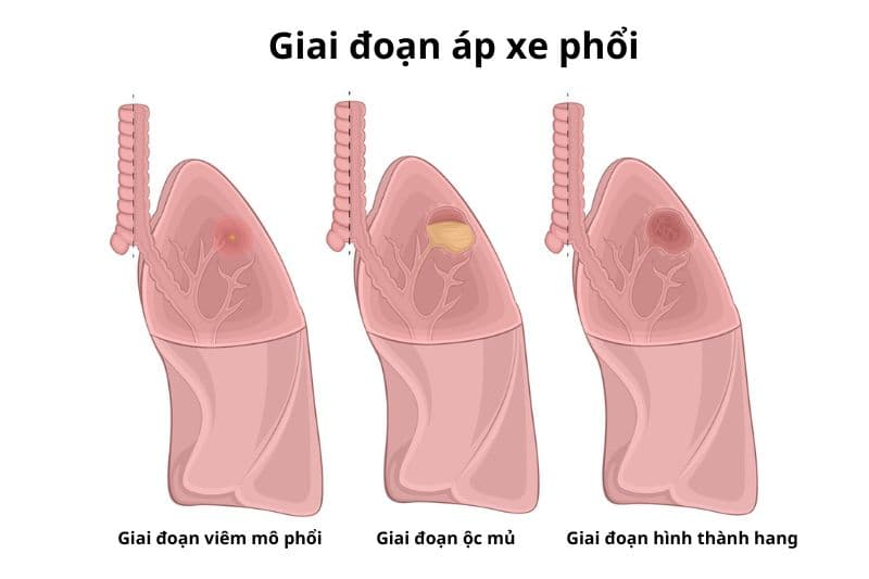 biểu hiện áp xe phổi các giai đoạn