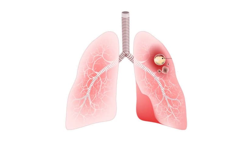 5 Biểu hiện áp xe phổi thường gặp cần lưu ý