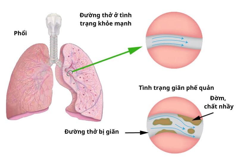 chẩn đoán giãn phế quản bằng nhiều phương pháp khác nhau