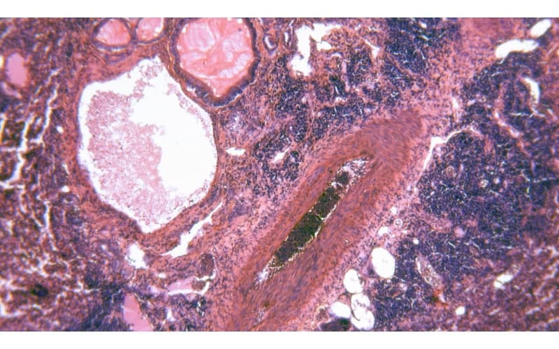 Vi khuẩn kị khí là nhóm tác nhân thường gặp nhất, chiếm trên 60% các trường hợp áp xe phổi
