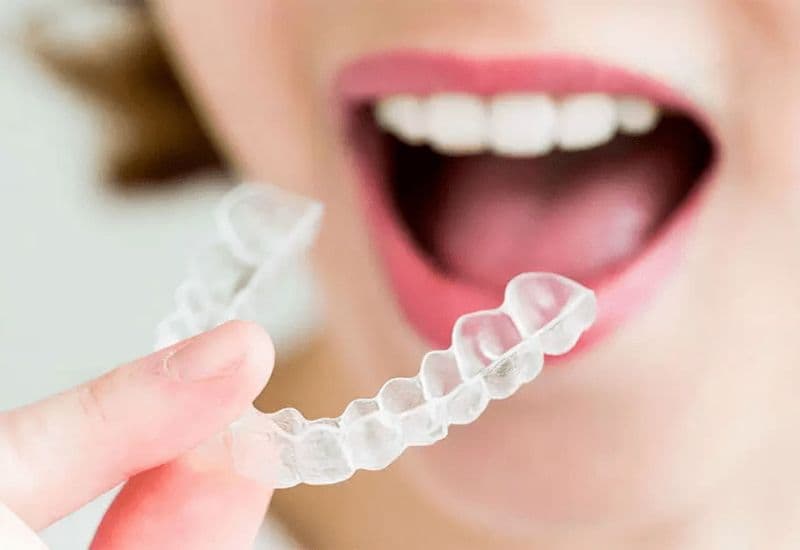 Nẹp răng trong suốt dễ tháo lắp, thuận tiện cho vệ sinh răng miệng và ăn uống