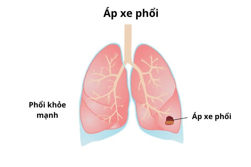 bệnh áp xe phổi