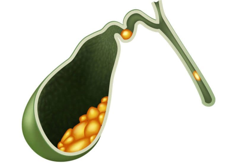 Các bệnh lý túi mật thường gặp