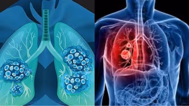 Bệnh ung thư phổi có chữa được không nếu điều trị tích cực