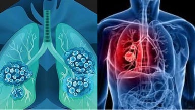 Bệnh ung thư phổi có chữa được không nếu điều trị tích cực