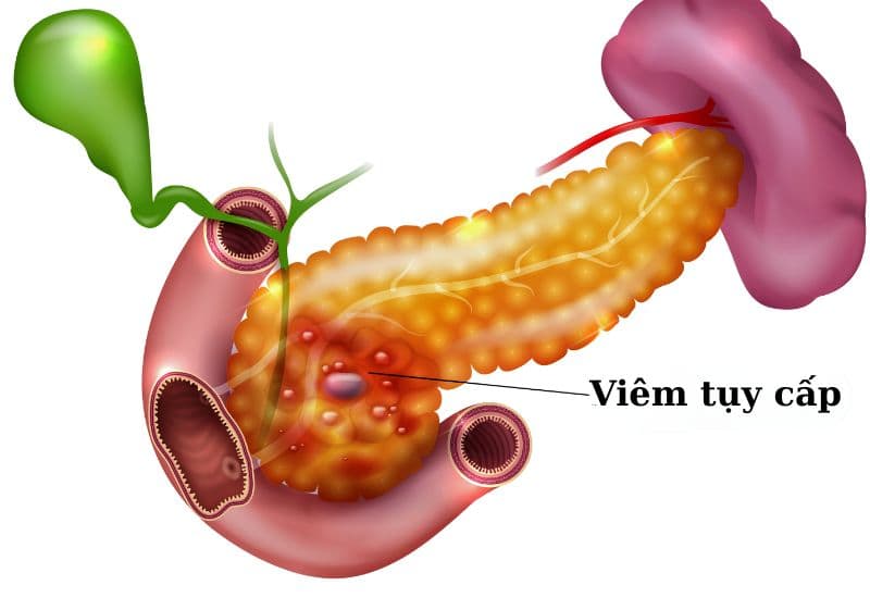 Những biến chứng nguy hiểm khi điều trị sỏi mật chậm trễ