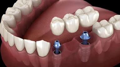 Bọc răng sứ Implant: Trồng răng bền vững chuẩn y khoa