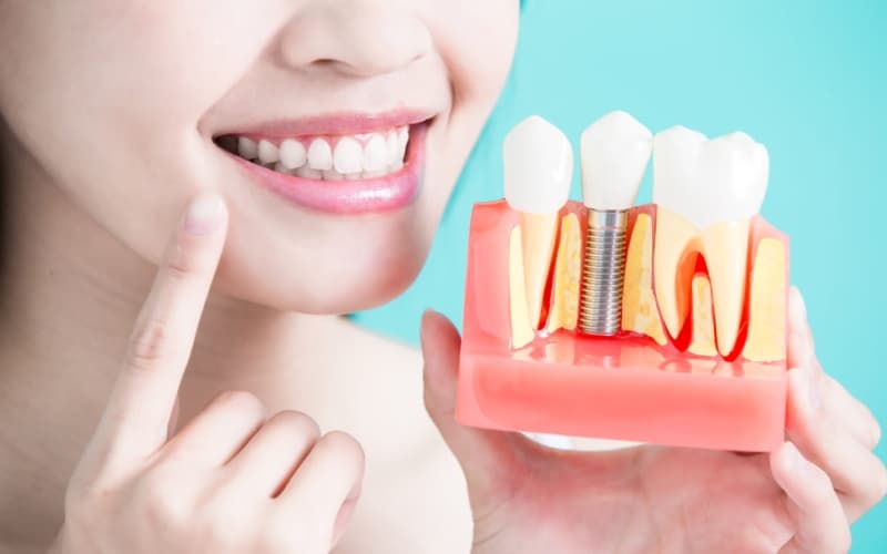 Những lợi ích vượt trội của bọc răng sứ Implant