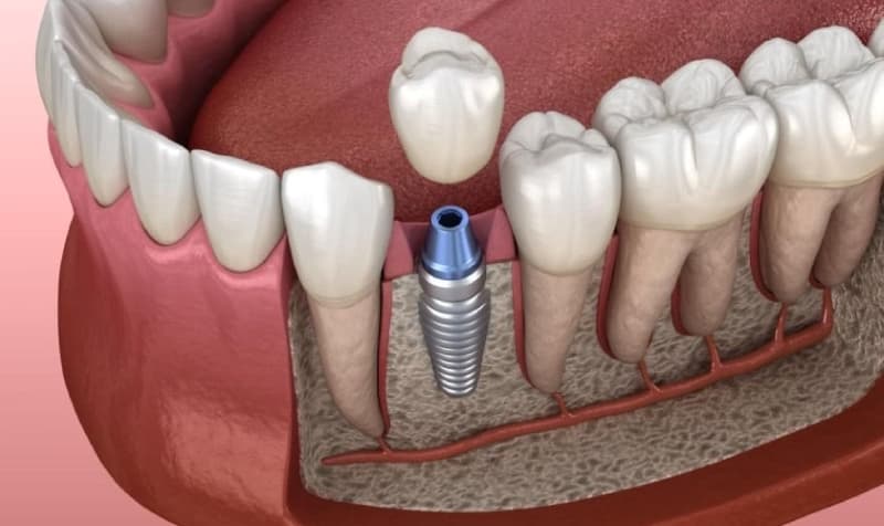 Kỹ thuật trồng răng Implant tiên tiến