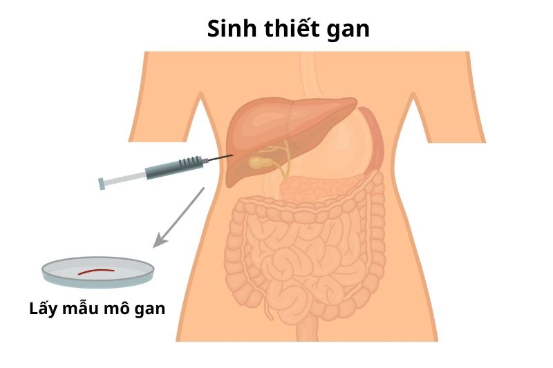 các bước kỹ thuật sinh thiết gan