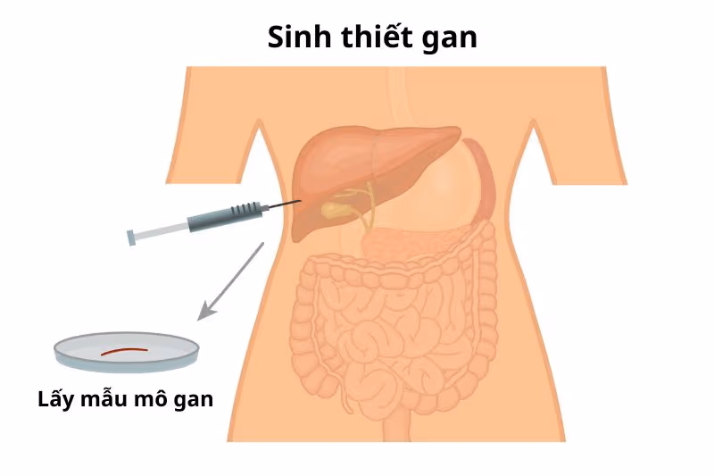 các bước kỹ thuật sinh thiết gan