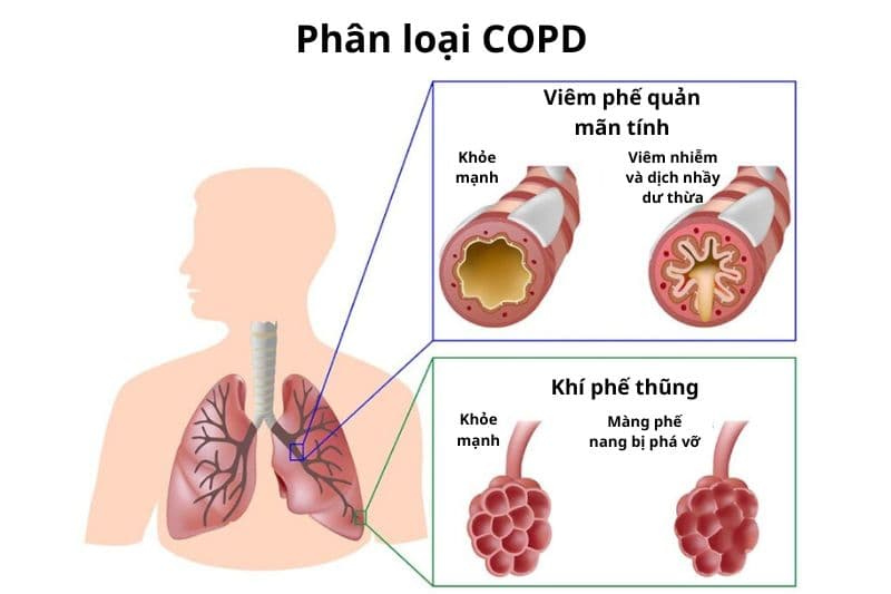 phổi tắc nghẽn mãn tính các loại