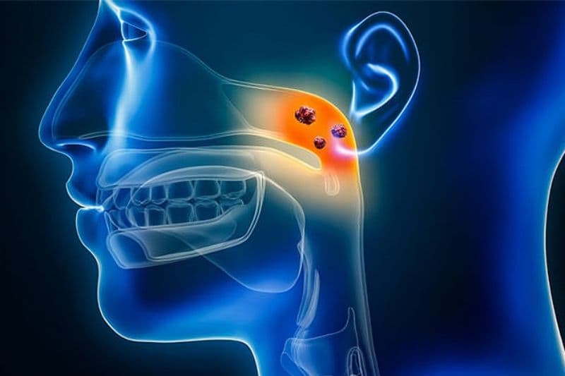 trị ung thư vòm họng giai đoạn 4