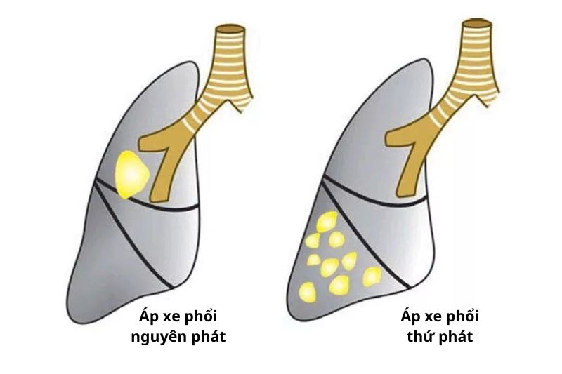 chẩn đoán và điều trị áp xe phổi