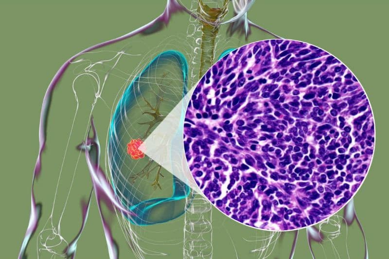 Ung thư phổi tế bào nhỏ