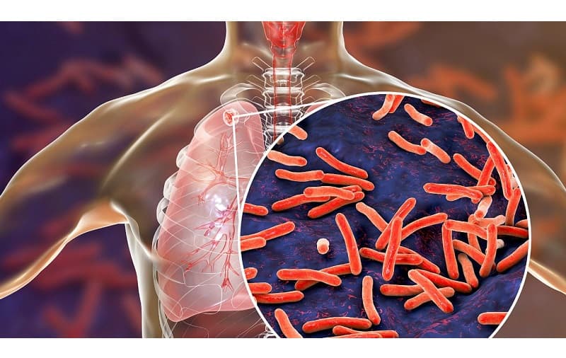 Khi bệnh lao đã chuyển sang thể hoạt động, đặc biệt là lao phổi, người bệnh cần được điều trị bệnh lao phổi bằng phác đồ thuốc kháng lao chuẩn trong thời gian tối thiểu từ 6 - 9 tháng