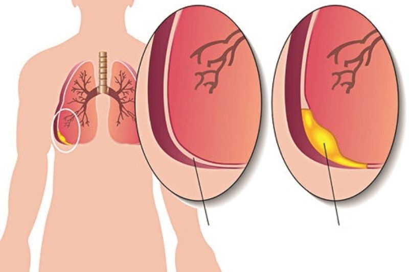 tràn mủ màng phổi