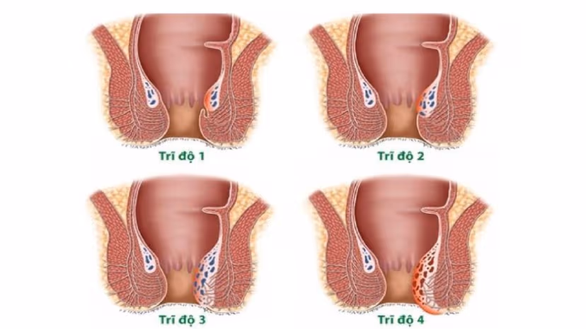 Laser Diode đột phá trong các cách chữa trĩ nội độ 2