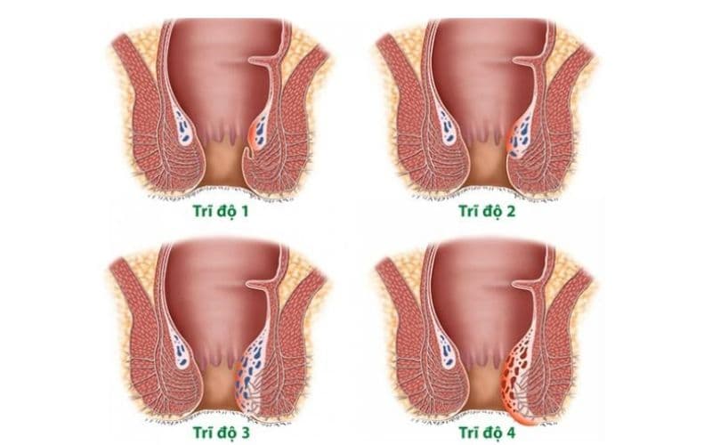 cách trị trĩ nội độ 2