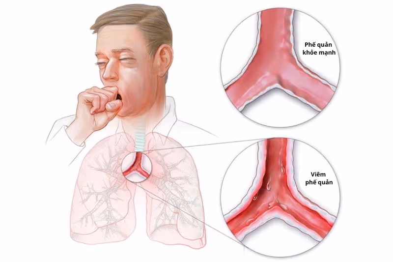 điều trị viêm phế quản cấp